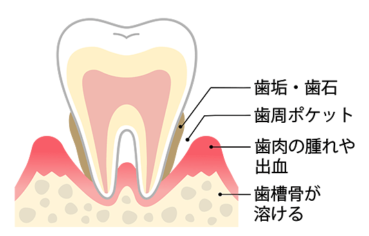 歯周ポケット